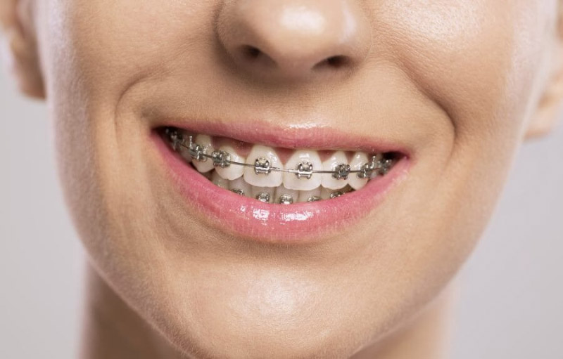 Niềng răng mắc cài kim loại là phương pháp chỉnh nha truyền thống
