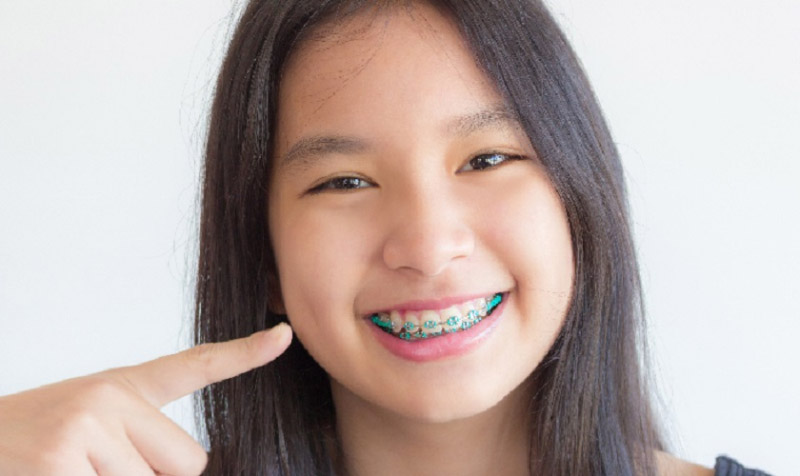 Độ tuổi của trẻ em phù hợp nhất để niềng răng là khoảng 6 - 12 tuổi