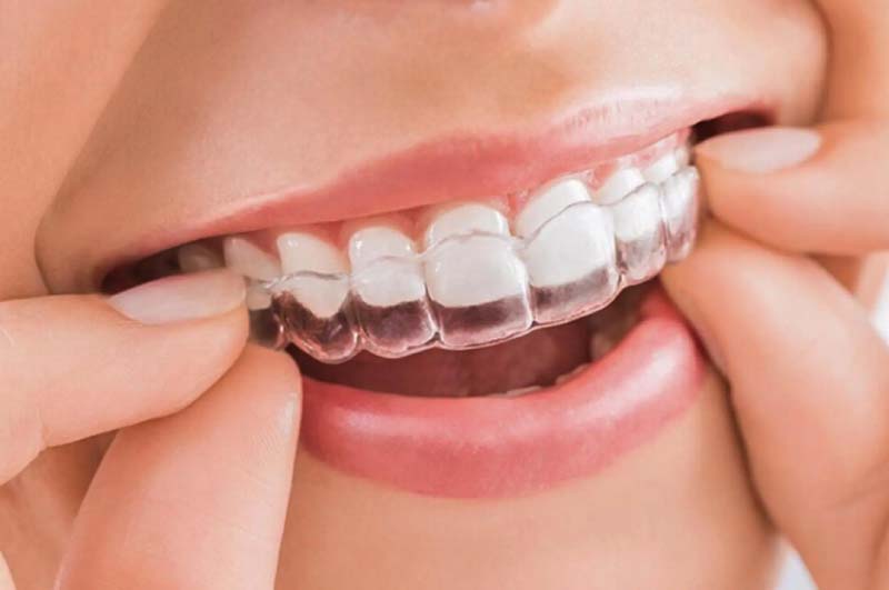 Niềng răng Invisalign là phương pháp được sử dụng phổ biến